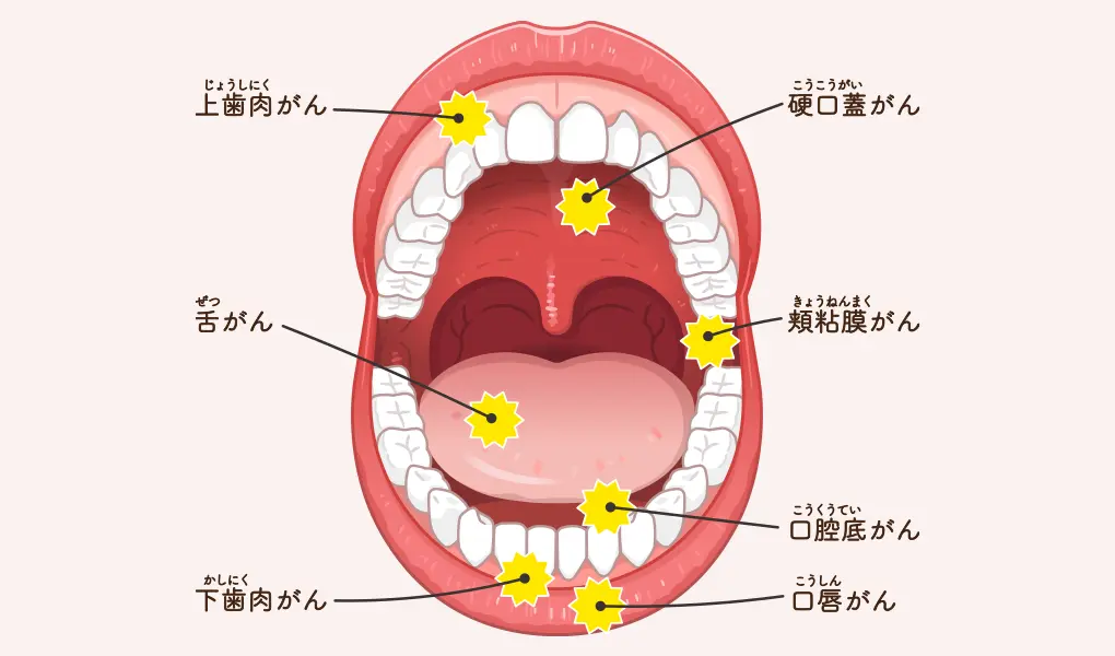 早期発見・早期が重要です