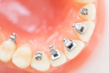 第2回矯正無料相談会のご案内